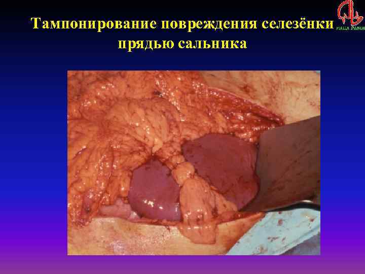 Тампонирование повреждения селезёнки прядью сальника 