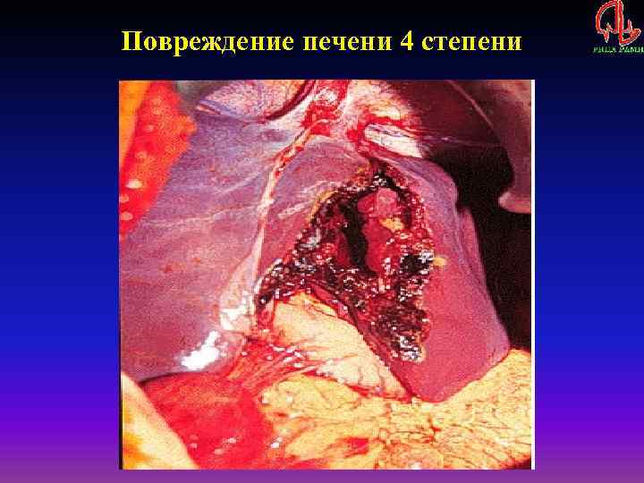 Повреждение печени 4 степени 