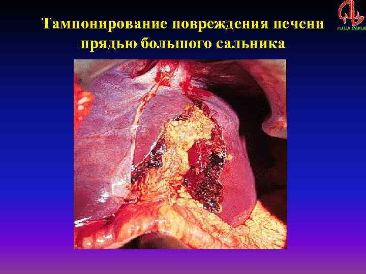 Тампонирование повреждения печени прядью большого сальника 