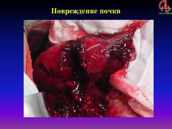 Повреждение почки 