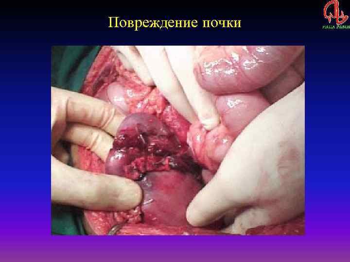 Повреждение почки 