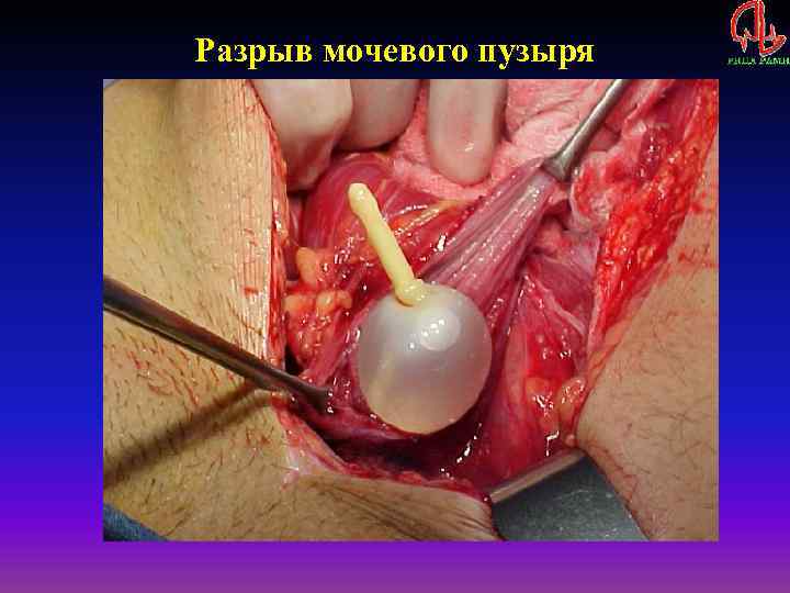 Разрыв мочевого пузыря 