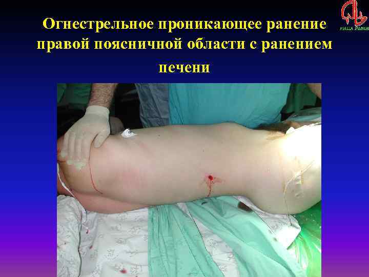 Огнестрельное проникающее ранение правой поясничной области с ранением печени 