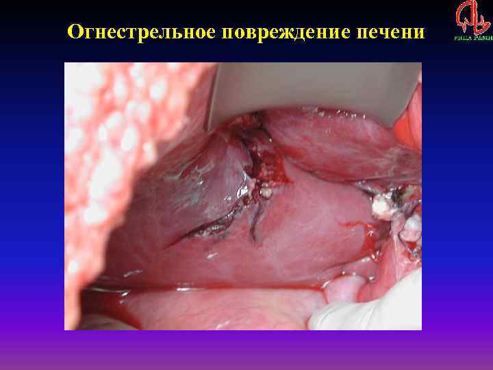 Огнестрельное повреждение печени 
