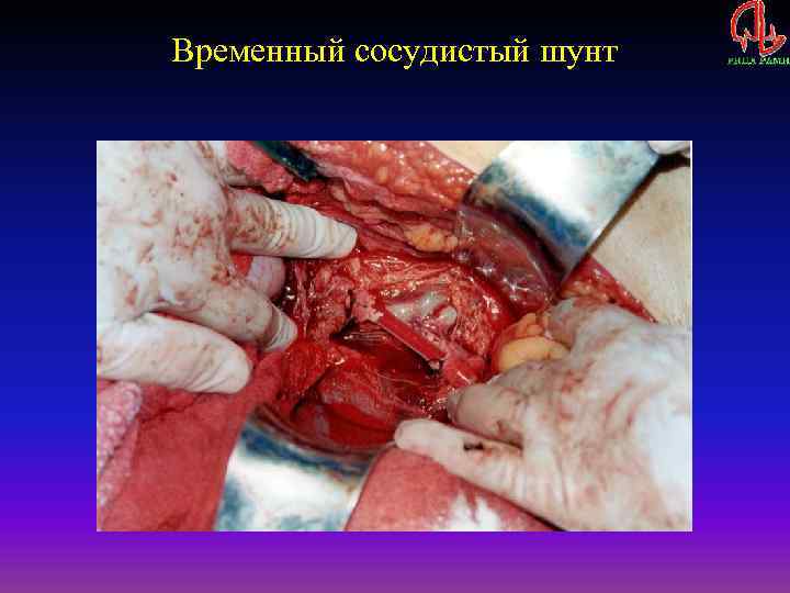 Временный сосудистый шунт 