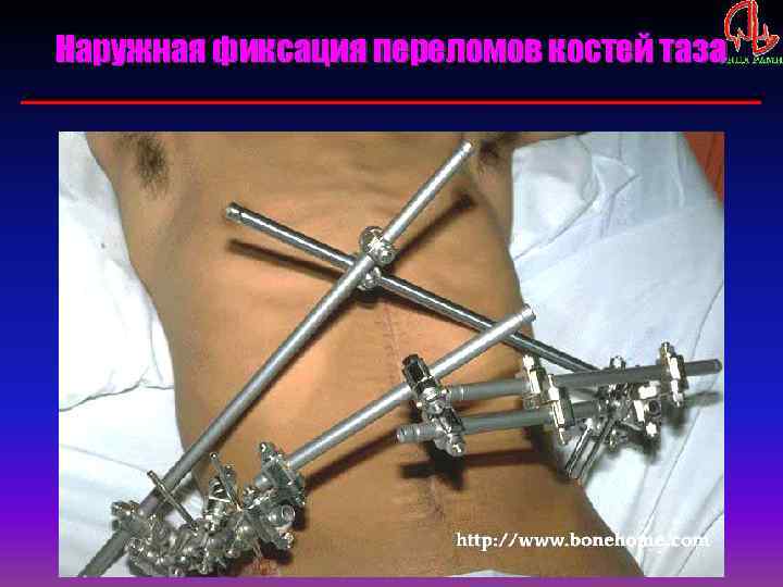 Наружная фиксация переломов костей таза 