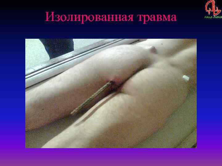 Изолированная травма 