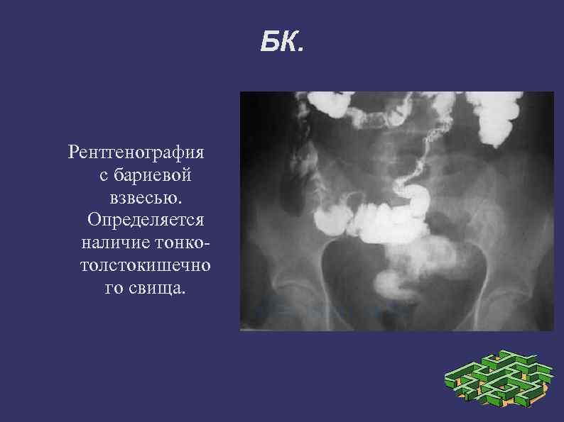 БК. Рентгенография с бариевой взвесью. Определяется наличие тонкотолстокишечно го свища. 