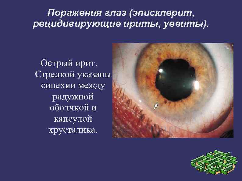 Поражения глаз (эписклерит, рецидивирующие ириты, увеиты). Острый ирит. Стрелкой указаны синехии между радужной оболчкой