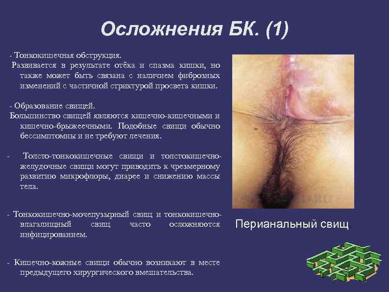 Осложнения БК. (1) - Тонкокишечная обструкция. Развивается в результате отёка и спазма кишки, но