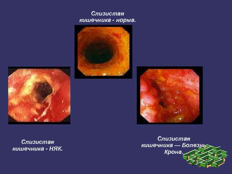 Слизистая кишечника - норма. Слизистая кишечника - НЯК. Слизистая кишечника — Болезнь Крона. 