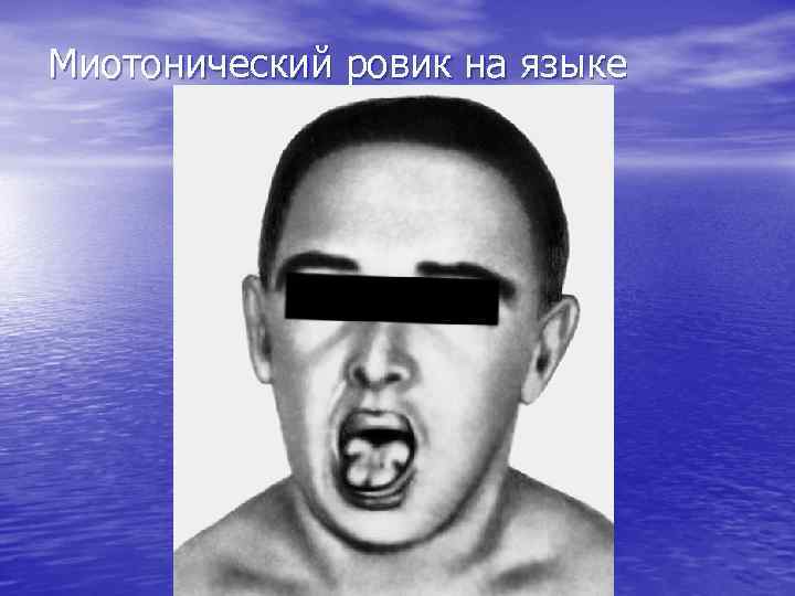 Миотонический ровик на языке 