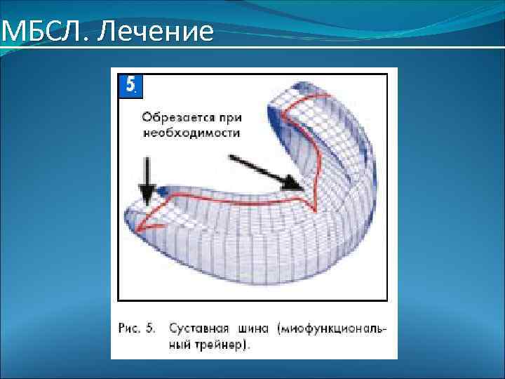 МБСЛ. Лечение 