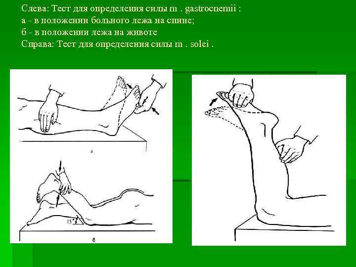 Слева: Тест для определения силы m. gastrocnemii : а - в положении больного лежа