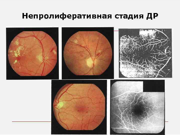 Диабеттік ретинопатия презентация