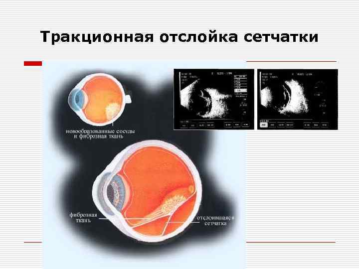 Отслойка сетчатки презентация