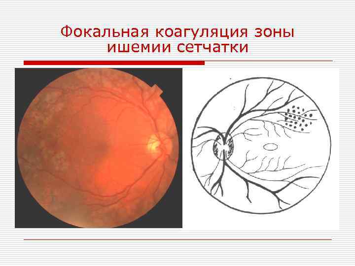 Фокальная коагуляция зоны ишемии сетчатки 