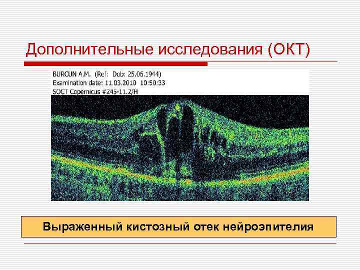 Дополнительные исследования (ОКТ) Выраженный кистозный отек нейроэпителия 