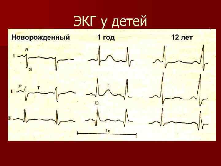 ЭКГ у детей 