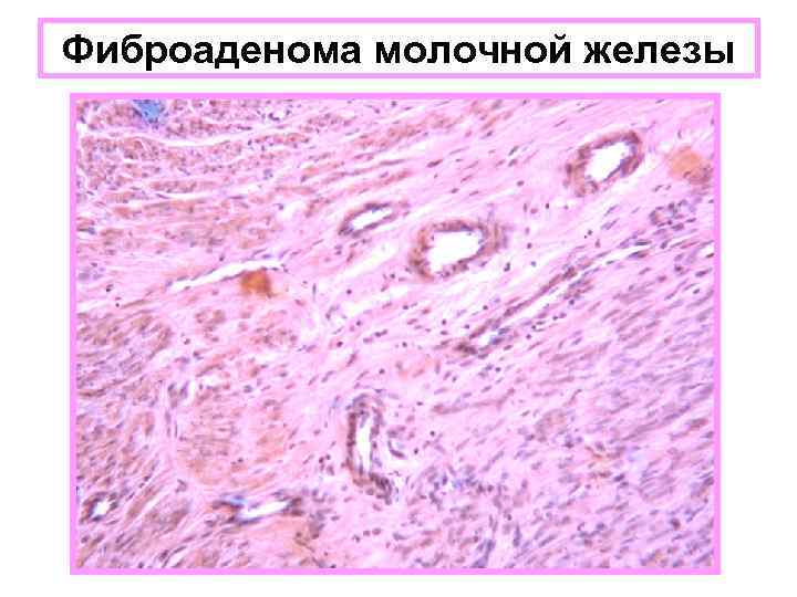 Фиброаденома молочной железы 