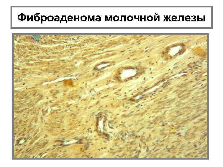 Фиброаденома молочной железы 