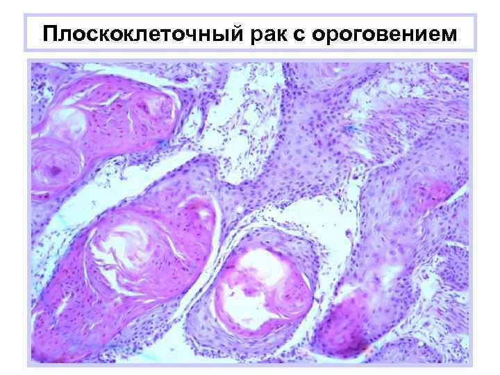 Плоскоклеточный рак с ороговением 