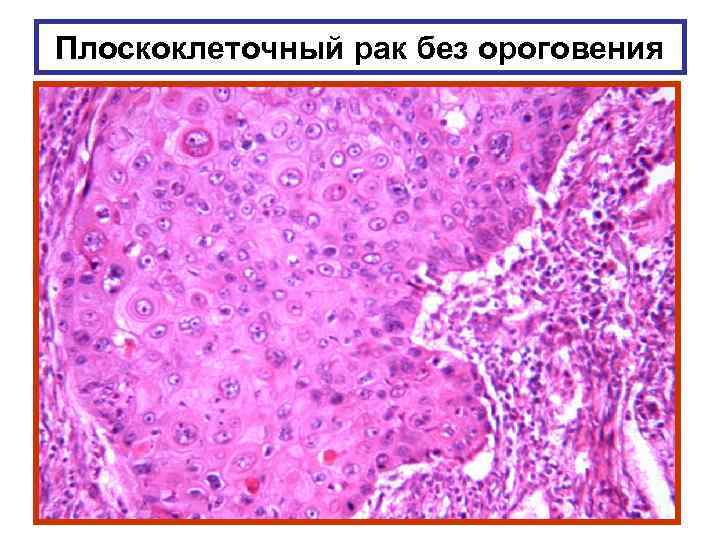 Плоскоклеточный рак без ороговения 