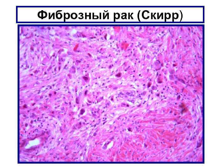 Фиброзный рак (Скирр) 