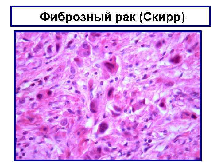 Фиброзный рак (Скирр) 