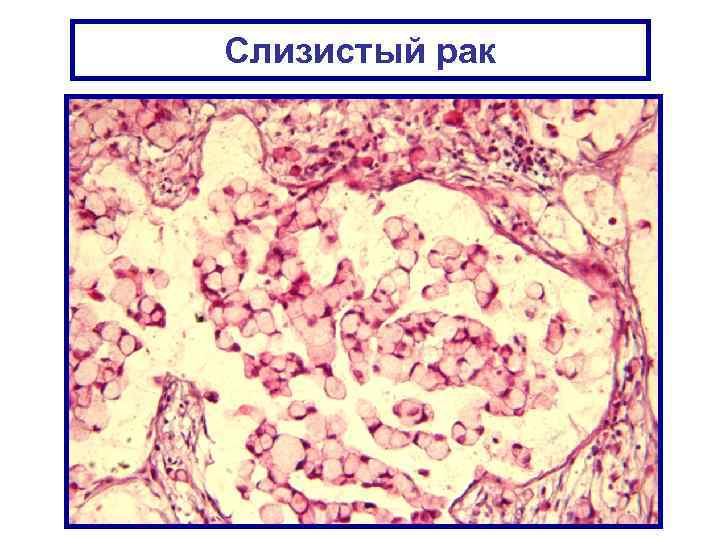 Слизистый рак 