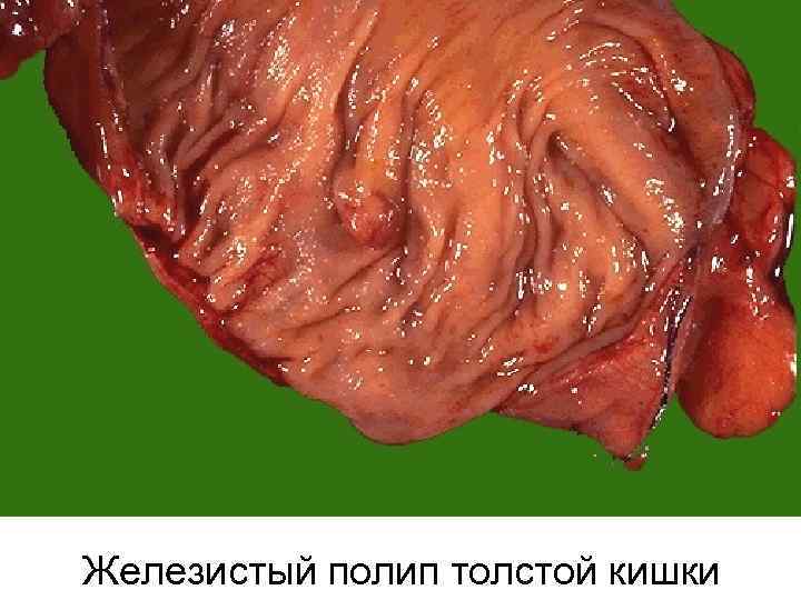Железистый полип толстой кишки 