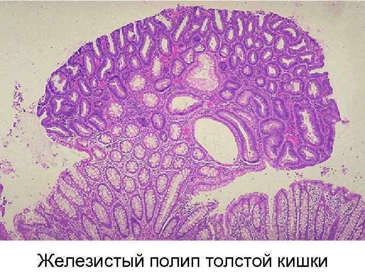 Железистый полип толстой кишки 