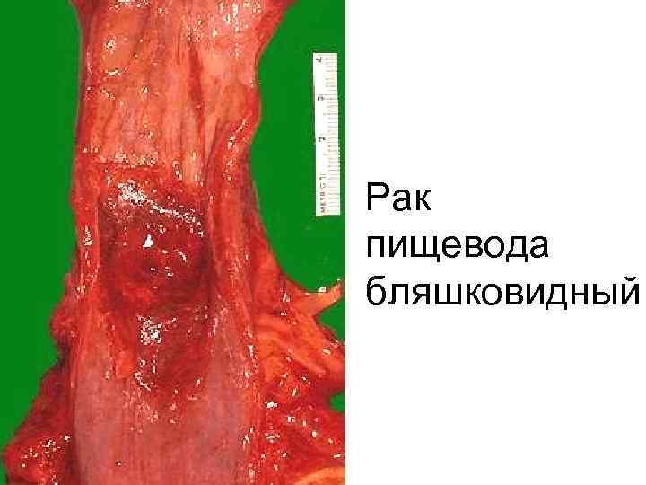 Рак пищевода бляшковидный 