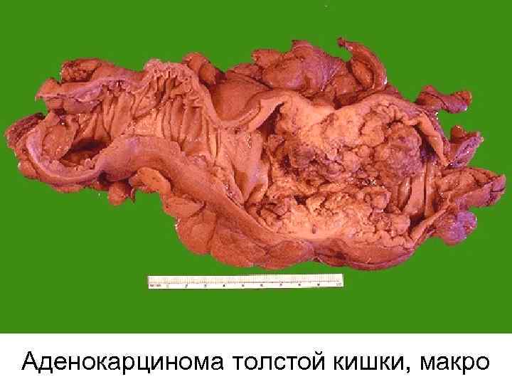 Аденокарцинома толстой кишки, макро 
