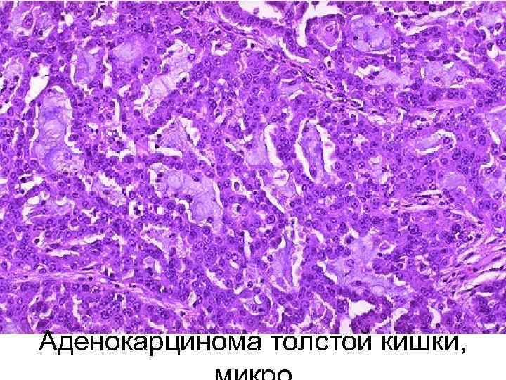 Аденокарцинома толстой кишки, 