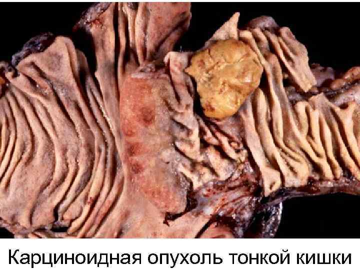 Карциноидная опухоль тонкой кишки 