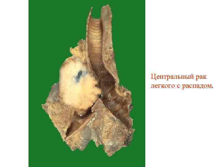 Центральный рак легкого с распадом. 