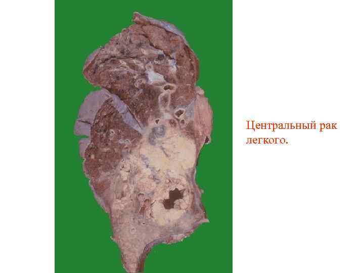 Центральный рак легкого. 