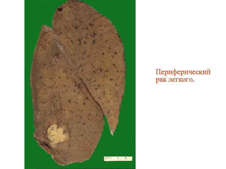 Периферический рак легкого. 