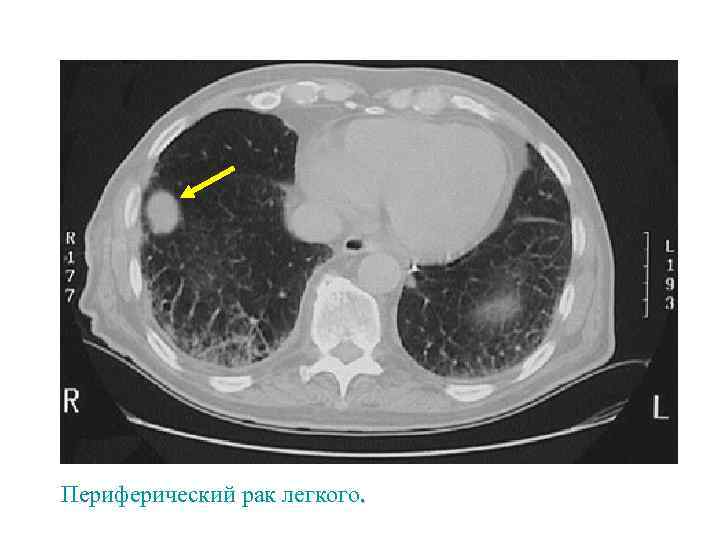 Периферический рак легкого. 