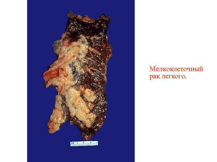 Мелкоклеточный рак легкого. 