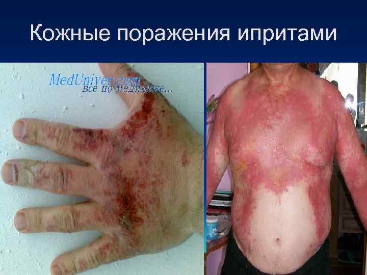 Кожные поражения ипритами 