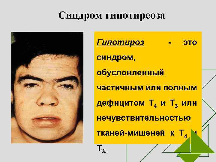 Синдром гипотиреоза Гипотироз - это синдром, обусловленный частичным или полным дефицитом Т 4 и