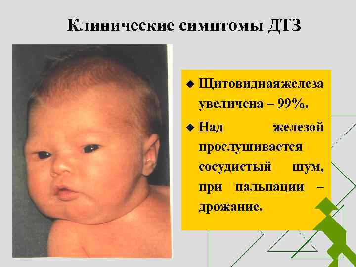 Клинические симптомы ДТЗ u Щитовидная железа увеличена – 99%. u Над железой прослушивается сосудистый