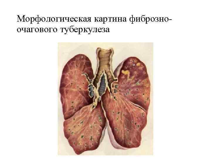 Морфологическая картина фиброзноочагового туберкулеза 
