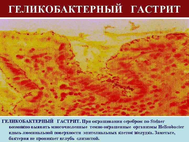 ГЕЛИКОБАКТЕРНЫЙ ГАСТРИТ. При окрашивании серебром по Steiner возможно выявить многочисленные темно окрашенные организмы Helicobacter