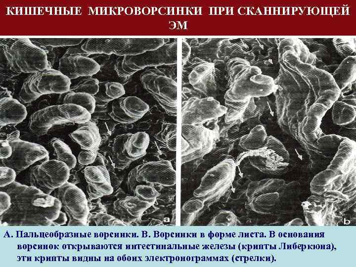 КИШЕЧНЫЕ МИКРОВОРСИНКИ ПРИ СКАННИРУЮЩЕЙ ЭМ А. Пальцеобразные ворсинки. В. Ворсинки в форме листа. В