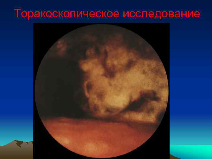 Торакоскопическое исследование 