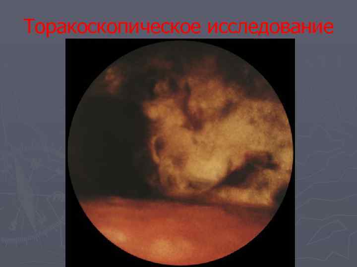 Торакоскопическое исследование 
