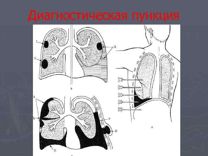 Диагностическая пункция 